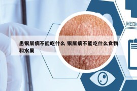 患银屑病不能吃什么 银屑病不能吃什么食物和水果