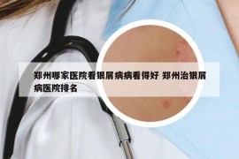 郑州哪家医院看银屑病病看得好 郑州治银屑病医院排名