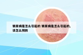 银屑病是怎么引起的 银屑病是怎么引起的,该怎么预防