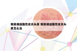 银屑病溢脂性皮炎头屑 银屑病溢脂性皮炎头屑怎么治