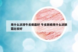 用什么润滑牛皮癣最好 牛皮肤癣用什么润肤霜比较好