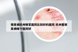 银屑病杭州哪家医院比较好的医院 杭州看银屑病哪个医院好