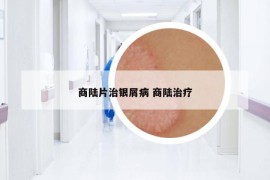 商陆片治银屑病 商陆治疗