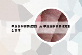 牛皮皮癣需要注意什么 牛皮皮癣需要注意什么事项