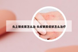 头上银皮屑怎么治 头皮银屑症状怎么治疗