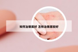 如何治银屑好 怎样治银屑较好