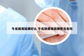 牛皮癣用硫磺好么 牛皮肤癣用硫磺肥皂有效