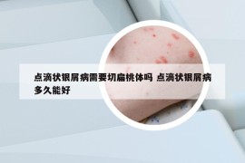 点滴状银屑病需要切扁桃体吗 点滴状银屑病多久能好