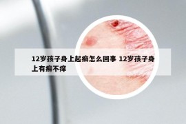 12岁孩子身上起癣怎么回事 12岁孩子身上有癣不痒