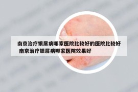 南京治疗银屑病哪家医院比较好的医院比较好 南京治疗银屑病哪家医院效果好