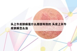 头上牛皮肤癣是什么原因导致的 头皮上长牛皮肤癣怎么治