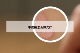 牛皮癣怎么做光疗