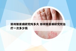 郑州银屑病研究所多大 郑州银屑病研究院治疗一次多少钱