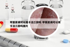 甲银屑病可以用卡泊三醇吗 甲银屑病可以用卡泊三醇吗图片