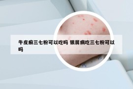 牛皮癣三七粉可以吃吗 银屑病吃三七粉可以吗