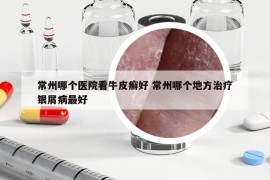 常州哪个医院看牛皮癣好 常州哪个地方治疗银屑病最好