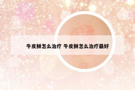 牛皮鲜怎么治疗 牛皮鲜怎么治疗最好