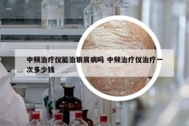 中频治疗仪能治银屑病吗 中频治疗仪治疗一次多少钱