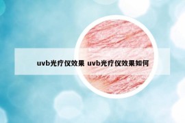 uvb光疗仪效果 uvb光疗仪效果如何