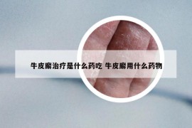 牛皮廨治疗是什么药吃 牛皮廨用什么药物