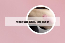 螃蟹泡酒能治癣吗 螃蟹用酒泡