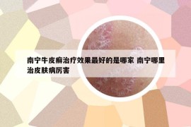 南宁牛皮癣治疗效果最好的是哪家 南宁哪里治皮肤病厉害