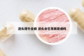 烫头得牛皮癣 烫头会引发银屑病吗