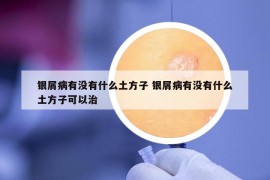 银屑病有没有什么土方子 银屑病有没有什么土方子可以治