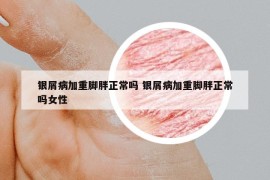 银屑病加重脚胖正常吗 银屑病加重脚胖正常吗女性