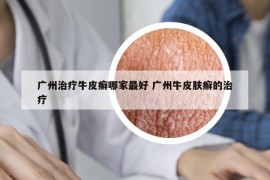 广州治疗牛皮癣哪家最好 广州牛皮肤癣的治疗