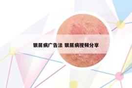 银屑病广告法 银屑病视频分享