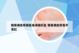 银屑病皮疹颜色变成暗红色 银屑病皮疹变平发红