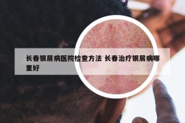 长春银屑病医院检查方法 长春治疗银屑病哪里好