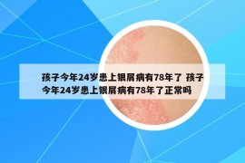 孩子今年24岁患上银屑病有78年了 孩子今年24岁患上银屑病有78年了正常吗