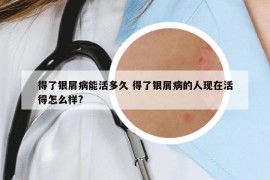 得了银屑病能活多久 得了银屑病的人现在活得怎么样?