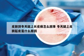 皮肤到冬天腿上长皮癣怎么回事 冬天腿上皮肤起皮是什么原因