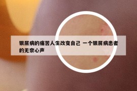 银屑病的痛苦人生改变自己 一个银屑病患者的无奈心声