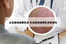 头皮癣用硫磺乳膏 头皮癣用硫磺乳膏管用吗