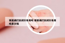 银屑病打封闭针有用吗 银屑病打封闭针有用吗多少钱