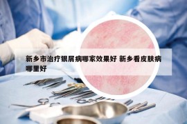 新乡市治疗银屑病哪家效果好 新乡看皮肤病哪里好