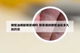 橄榄油缓解银屑病吗 银屑病抹橄榄油后多久抹药膏