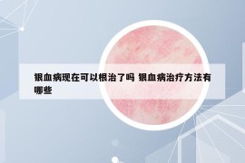 银血病现在可以根治了吗 银血病治疗方法有哪些