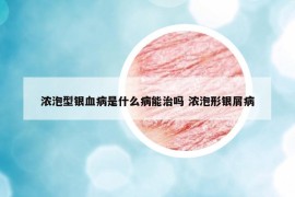 浓泡型银血病是什么病能治吗 浓泡形银屑病