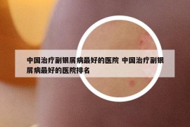 中国治疗副银屑病最好的医院 中国治疗副银屑病最好的医院排名