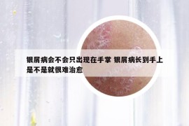 银屑病会不会只出现在手掌 银屑病长到手上是不是就很难治愈