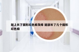 腿上长了圆形红色癣发痒 腿部长了几个圆形红色癣