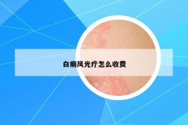 白癜风光疗怎么收费