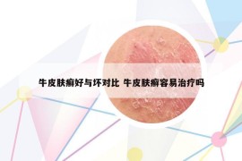 牛皮肤癣好与坏对比 牛皮肤癣容易治疗吗