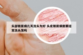 头部银屑病几天洗头为好 头皮银屑病需要经常洗头发吗