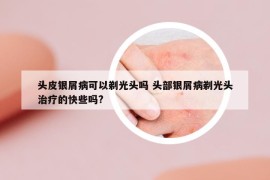 头皮银屑病可以剃光头吗 头部银屑病剃光头治疗的快些吗?